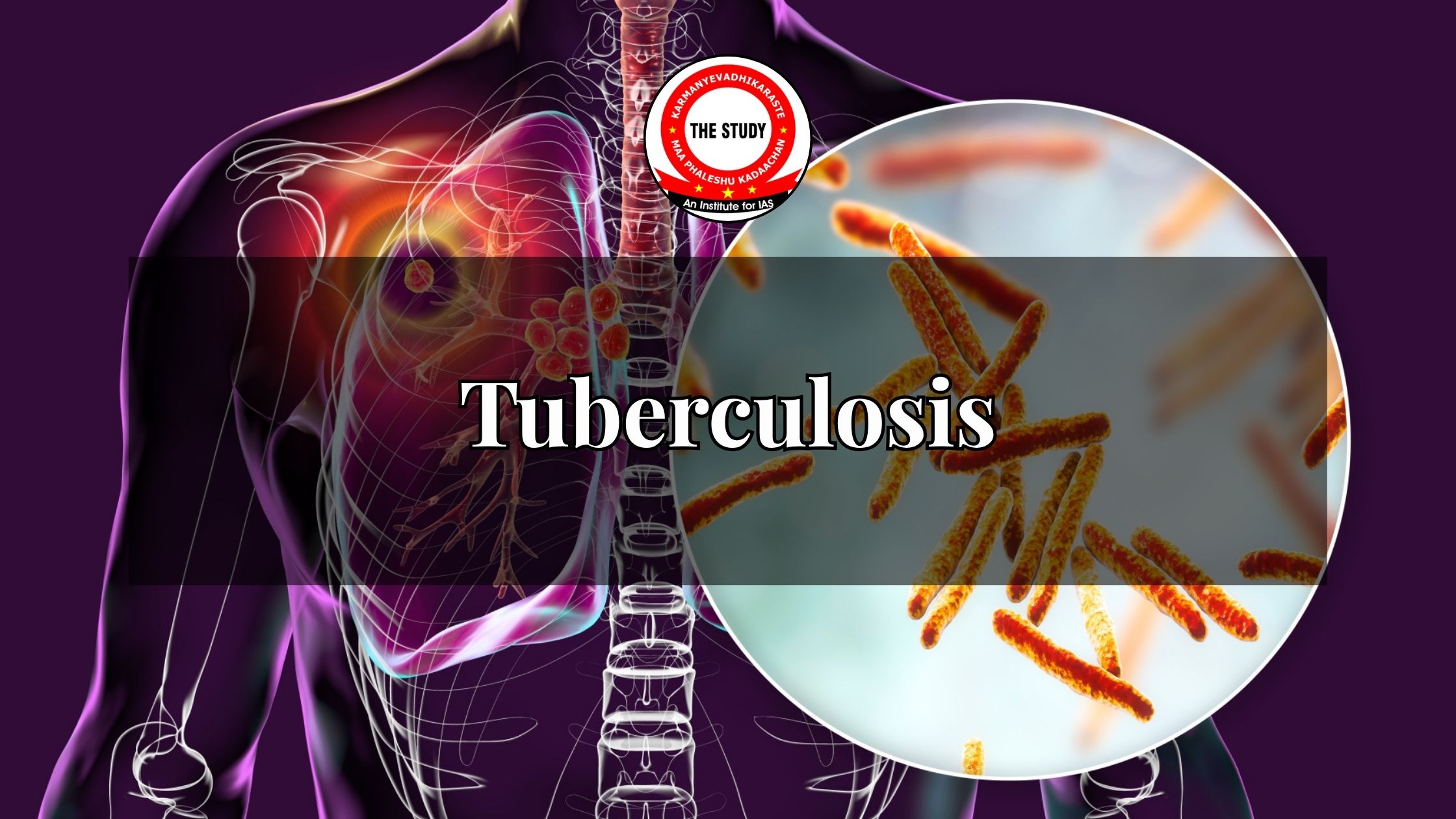 Tuberculosis in India