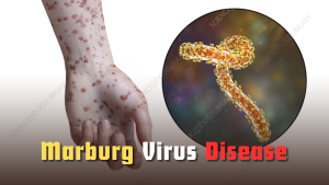 Marburg Virus Disease 