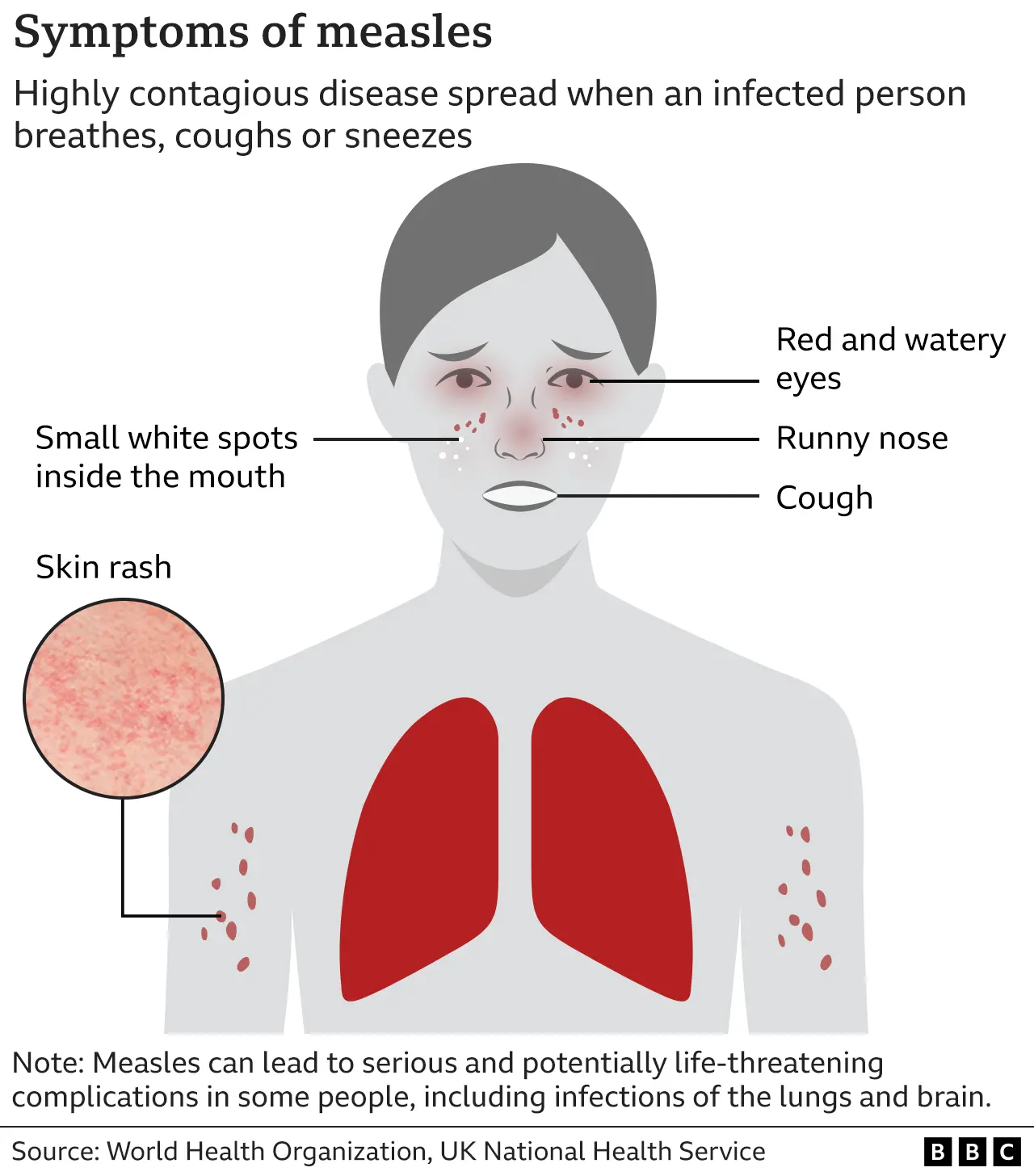 The Measles Vaccine
