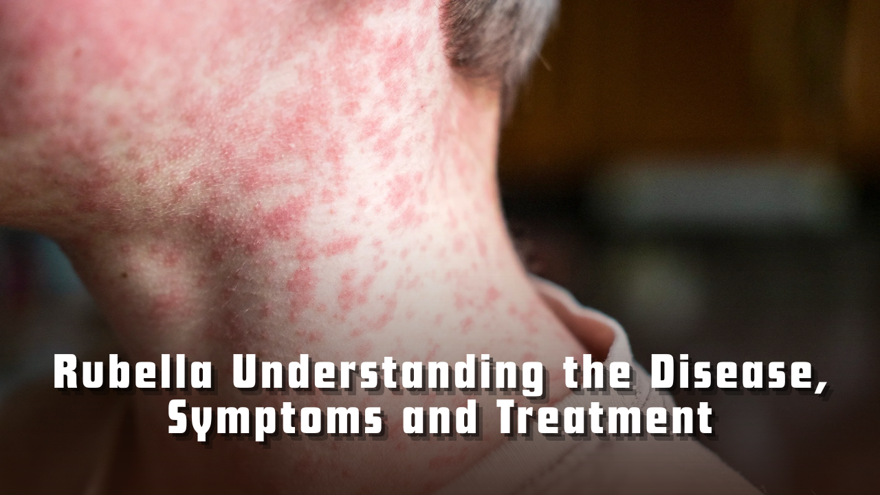 Rubella: Understanding the Disease, Symptoms, and Treatment